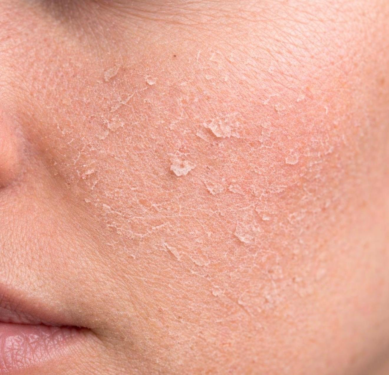 Close view of visibly dry facial skin